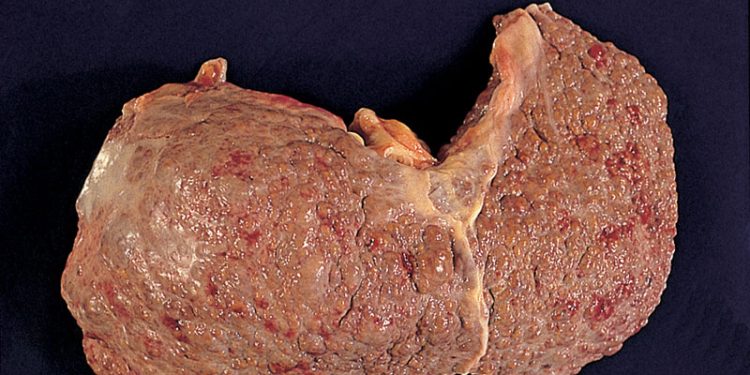 Hepatitis C: del alba al ocaso