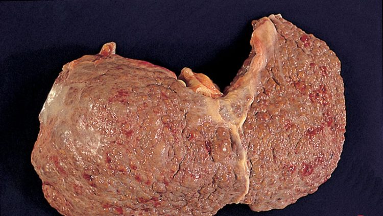 Hepatitis C: del alba al ocaso