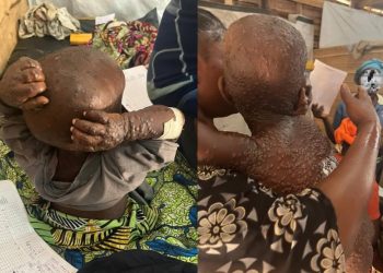 La FCOMCI crea un nuevo grupo de trabajo para abordar la emergencia de salud pública de la viruela del mono