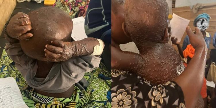 La FCOMCI crea un nuevo grupo de trabajo para abordar la emergencia de salud pública de la viruela del mono