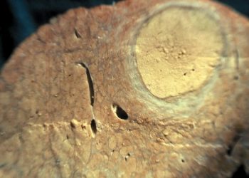 En el día Mundial del Cáncer de Hígado-30 de octubre