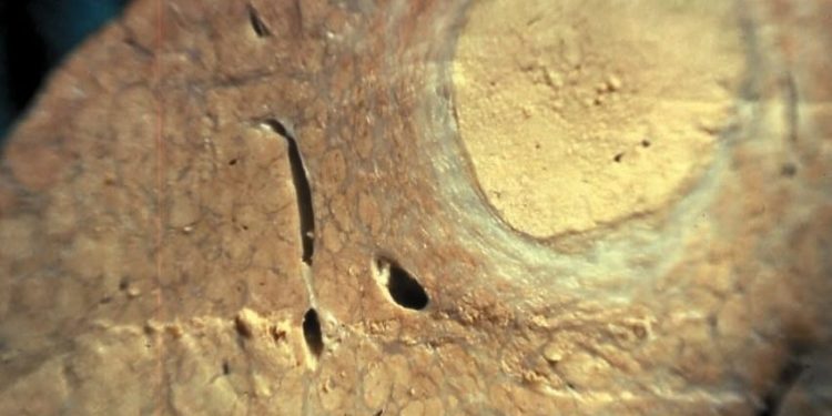 En el día Mundial del Cáncer de Hígado-30 de octubre